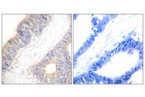 Immunohistochemistry analysis of paraffin-embedded human colon carcinoma tissue using Stefin A antibody. (CSTA Antikörper  (Internal Region))
