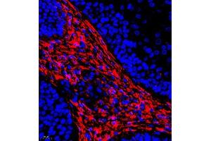 Immunofluorescence of paraffin embedded human laryngocarcinoma using CRMP3 (ABIN7073734) at dilution of 1:650 (400x lens) (DPYSL4 Antikörper)