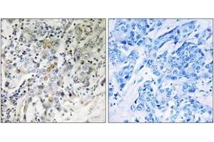Immunohistochemistry analysis of paraffin-embedded human breast carcinoma tissue, using ELL2 Antibody. (ELL2 Antikörper  (AA 448-497))