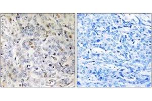 Immunohistochemistry analysis of paraffin-embedded human breast carcinoma tissue, using PDIK1L Antibody. (PDIK1L Antikörper  (AA 101-150))