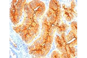 Immunohistochemical staining (Formalin-fixed paraffin-embedded sections) of human colon cancer with tag-72 monoclonal antibody, clone SPM148 . (TAG-72 Antikörper)
