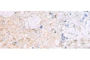Immunohistochemistry of paraffin-embedded Human gastric cancer tissue using DPCD Polyclonal Antibody at dilution of 1:50(x200) (DPCD Antikörper)