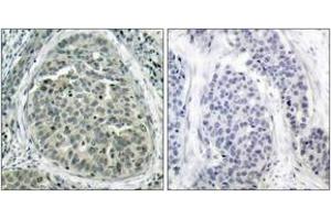 Immunohistochemistry analysis of paraffin-embedded human breast carcinoma, using Catenin-beta (Phospho-Ser37) Antibody. (beta Catenin Antikörper  (pSer37))