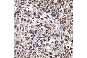 Immunohistochemistry of paraffin-embedded human well-differentiated squamous skin carcinoma using DNAJB6 antibody at dilution of 1:100 (x400 lens). (DNAJB6 Antikörper)