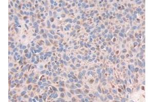 Detection of ECH1 in Human Skin cancer Tissue using Polyclonal Antibody to Enoyl Coenzyme A Hydratase 1, Peroxisomal (ECH1)