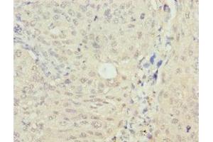 Immunohistochemistry of paraffin-embedded human lung cancer using ABIN7160268 at dilution of 1: 100 (RAE1 Antikörper  (AA 1-368))