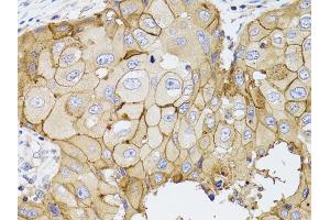 Immunohistochemistry of paraffin-embedded human breast cancer using PDE4D antibody (ABIN5970821) at dilution of 1/100 (40x lens).