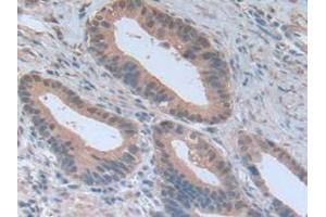 Detection of NOTCH4 in Human Stomach Cancer Tissue using Polyclonal Antibody to Notch Homolog 4 (NOTCH4) (NOTCH4 Antikörper  (AA 1715-2001))