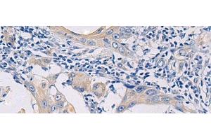 Immunohistochemistry of paraffin-embedded Human esophagus cancer tissue using GALR3 Polyclonal Antibody at dilution of 1:50(x200) (GALR3 Antikörper)