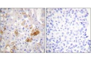 Immunohistochemistry analysis of paraffin-embedded human breast carcinoma, using Integrin beta1 (Phospho-Thr788) Antibody. (ITGB1 Antikörper  (pThr788))