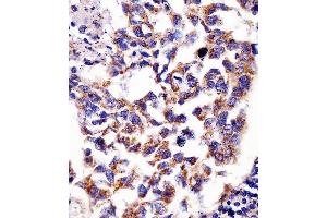 (ABIN6242390 and ABIN6578681) staining Hsp60 in human lung adenocarcinoma tissue sections by Immunohistochemistry (IHC-P - paraformaldehyde-fixed, paraffin-embedded sections). (HSPD1 Antikörper  (AA 396-430))