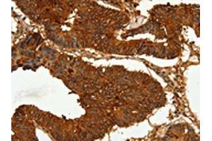 The image on the left is immunohistochemistry of paraffin-embedded Human colon cancer tissue using ABIN7128894(CEACAM21 Antibody) at dilution 1/60, on the right is treated with fusion protein. (CEACAM21 Antikörper)