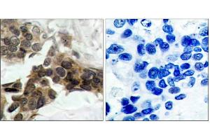 Immunohistochemical analysis of paraffin-embedded human breast carcinoma tissue, using IκB-α (phospho-Ser32/Ser36) antibody (E011152) . (NFKBIA Antikörper  (pSer32, pSer36))