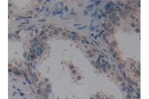 Detection of VIL in Human Prostate Tissue using Polyclonal Antibody to Villin (VIL) (Villin 1 Antikörper  (AA 1-320))