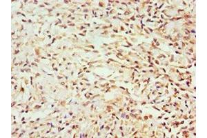 Immunohistochemistry of paraffin-embedded human breast cancer using ABIN7154587 at dilution of 1:100 (GEM Antikörper  (AA 1-150))