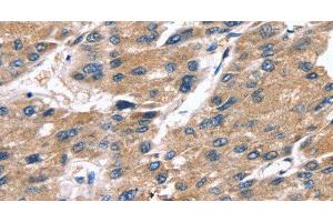 Immunohistochemistry of paraffin-embedded Human liver cancer tissue using SRGN Polyclonal Antibody at dilution 1:25 (SRGN Antikörper)