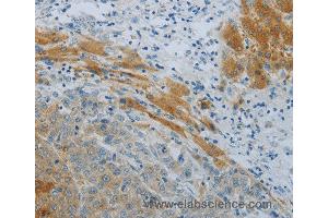 Immunohistochemistry of Human liver cancer using NPHS1 Polyclonal Antibody at dilution of 1:40 (Nephrin Antikörper)