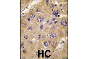 Formalin-fixed and paraffin-embedded human hepatocellular carcinoma reacted with ALDH6A1 polyclonal antibody  , which was peroxidase-conjugated to the secondary antibody, followed by DAB staining. (ALDH6A1 Antikörper  (C-Term))