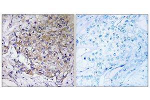 Immunohistochemistry analysis of paraffin-embedded human breast carcinoma tissue, using WASF3antibody. (WASF3 Antikörper  (Internal Region))