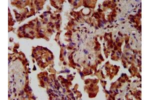 IHC image of ABIN7169088 diluted at 1:300 and staining in paraffin-embedded human lung cancer performed on a Leica BondTM system.