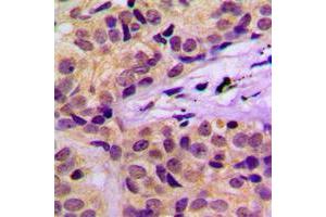 Immunohistochemical analysis of c-CBL (pY674) staining in human cervical cancer formalin fixed paraffin embedded tissue section. (CBL Antikörper  (pTyr674))