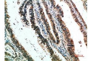 Immunohistochemical analysis of paraffin-embedded human-colon-cancer, antibody was diluted at 1:200 (CLEC4A Antikörper  (AA 161-210))