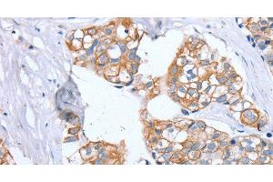 Immunohistochemistry of paraffin-embedded Human breast cancer using PTP4A2 Polyclonal Antibody at dilution of 1:30 (PTP4A2 Antikörper)