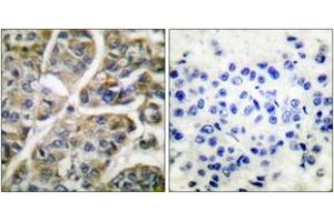Immunohistochemistry analysis of paraffin-embedded human breast carcinoma tissue, using Granzyme B Antibody. (GZMB Antikörper  (AA 10-59))