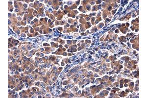 IHC-P Image Calpastatin antibody detects Calpastatin protein at cytoplasm in human lung cancer by immunohistochemical analysis. (Calpastatin Antikörper)
