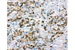 IHC-P: ALDH3A1 antibody testing of human gastric cancer tissue (ALDH3A1 Antikörper  (C-Term))