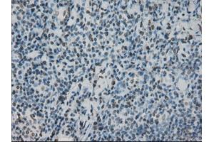 Immunohistochemical staining of paraffin-embedded lymphoma tissue using anti-PRKYmouse monoclonal antibody. (PRKY Antikörper)