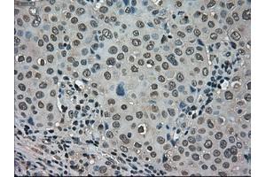 Immunohistochemical staining of paraffin-embedded Carcinoma of kidney tissue using anti-LDHAmouse monoclonal antibody. (Lactate Dehydrogenase A Antikörper)