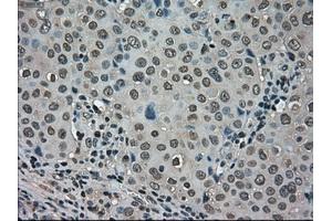 Immunohistochemical staining of paraffin-embedded Carcinoma of kidney tissue using anti-LDHAmouse monoclonal antibody.