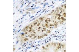 Immunohistochemical analysis of Cullin 4A staining in human colon cancer formalin fixed paraffin embedded tissue section. (Cullin 4A Antikörper)