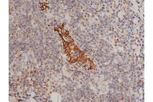 ABIN6267311 at 1/200 staining human breast cancer tissue sections by IHC-P. (KRT8 Antikörper  (pSer432))