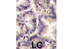 Formalin-fixed and paraffin-embedded human lung carcinoma tissue reacted with VEGFC polyclonal antibody  , which was peroxidase-conjugated to the secondary antibody, followed by DAB staining. (VEGFC Antikörper  (Internal Region))