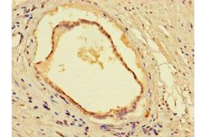 Immunohistochemistry of paraffin-embedded human prostate cancer using ABIN7160974 at dilution of 1:100 (CYB5R1 Antikörper  (AA 29-305))