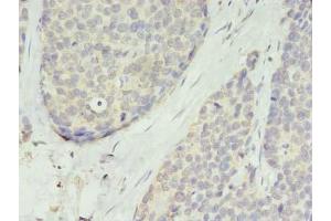Immunohistochemistry of paraffin-embedded human gastric cancer using ABIN7173225 at dilution of 1:100 (TMEM45A Antikörper  (AA 171-217))