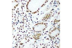 Immunohistochemical analysis of DR1 staining in human gastric cancer formalin fixed paraffin embedded tissue section. (DR1 Antikörper)