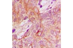 Immunohistochemical analysis of PPM1K staining in human breast cancer formalin fixed paraffin embedded tissue section. (PPM1K Antikörper)