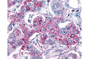 Anti-GRM8 / MGLUR8 antibody IHC of human Pancreas, Carcinoma. (GRM8 Antikörper  (N-Term))
