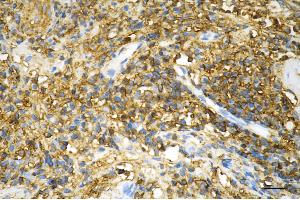 Immunohistochemistry was performed on paraffin-embedded human bladder carcinoma using CD44 antibody (ABIN7797972), 1:200). (Rekombinanter CD44 Antikörper)