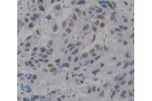 IHC-P analysis of breast tissue, with DAB staining. (TDP1 Antikörper  (AA 4-215))