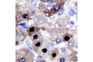 Immunohistochemical analysis of BCL11A staining in human liver cancer formalin fixed paraffin embedded tissue section.