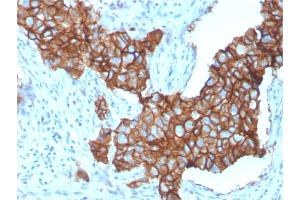 Formalin-fixed, paraffin-embedded human Breast Carcinoma stained with HER-2 Monospecific Mouse Monoclonal Antibody (ERBB2/3257). (ErbB2/Her2 Antikörper  (AA 311-462))
