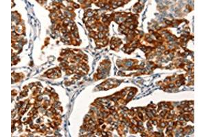 The image on the left is immunohistochemistry of paraffin-embedded Human breast cancer tissue using ABIN7189718(AGO4 Antibody) at dilution 1/25, on the right is treated with synthetic peptide. (AGO4 Antikörper)