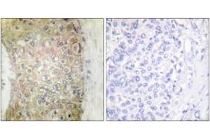 Immunohistochemistry analysis of paraffin-embedded human breast carcinoma tissue, using HSP20 (Ab-16) Antibody. (HSPB6 Antikörper  (AA 5-54))