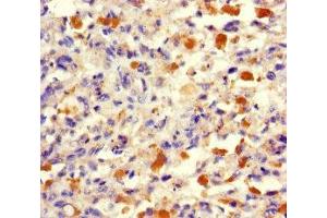 Immunohistochemistry of paraffin-embedded human melanoma using ABIN7173512 at dilution of 1:100 (TRMT112 Antikörper  (AA 1-125))