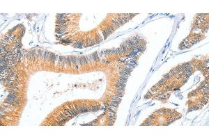 Immunohistochemistry of paraffin-embedded Human colon cancer using ACY3 Polyclonal Antibody at dilution of 1:35 (Aminoacylase 3 Antikörper)