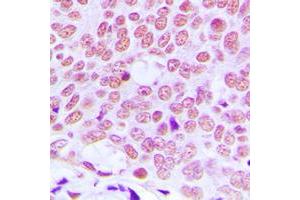 Immunohistochemical analysis of c-Jun staining in human breast cancer formalin fixed paraffin embedded tissue section. (C-JUN Antikörper  (Center))